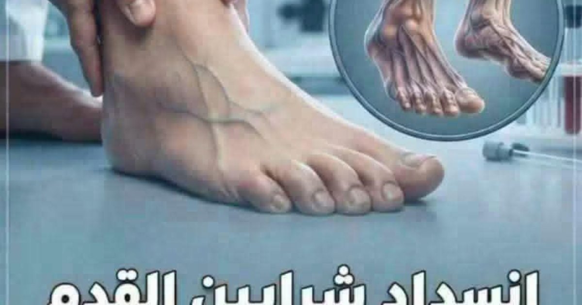 انسداد شرايين القدم والساق للأسباب، الأعراض وطرق العلاج